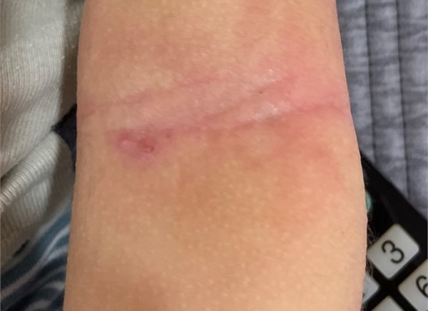아토피 피부염